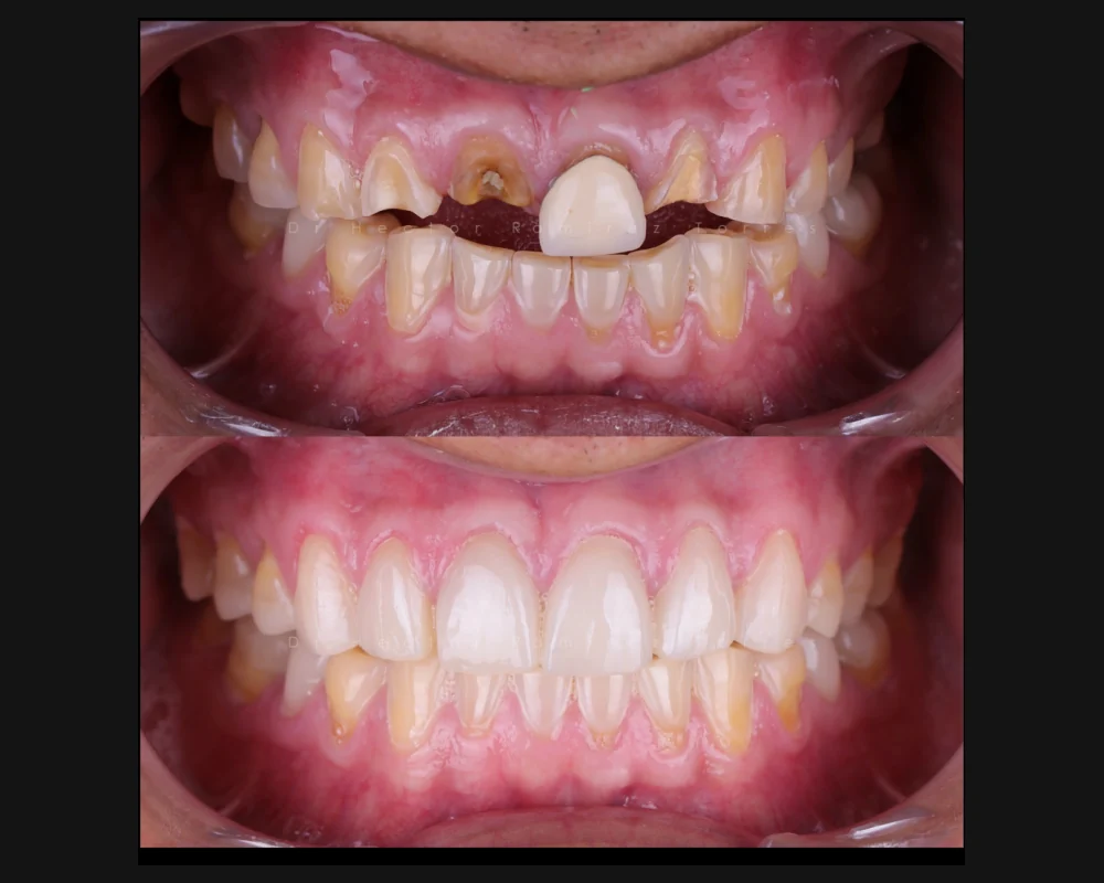 Antes y después de una rehabilitación de los dientes superiores