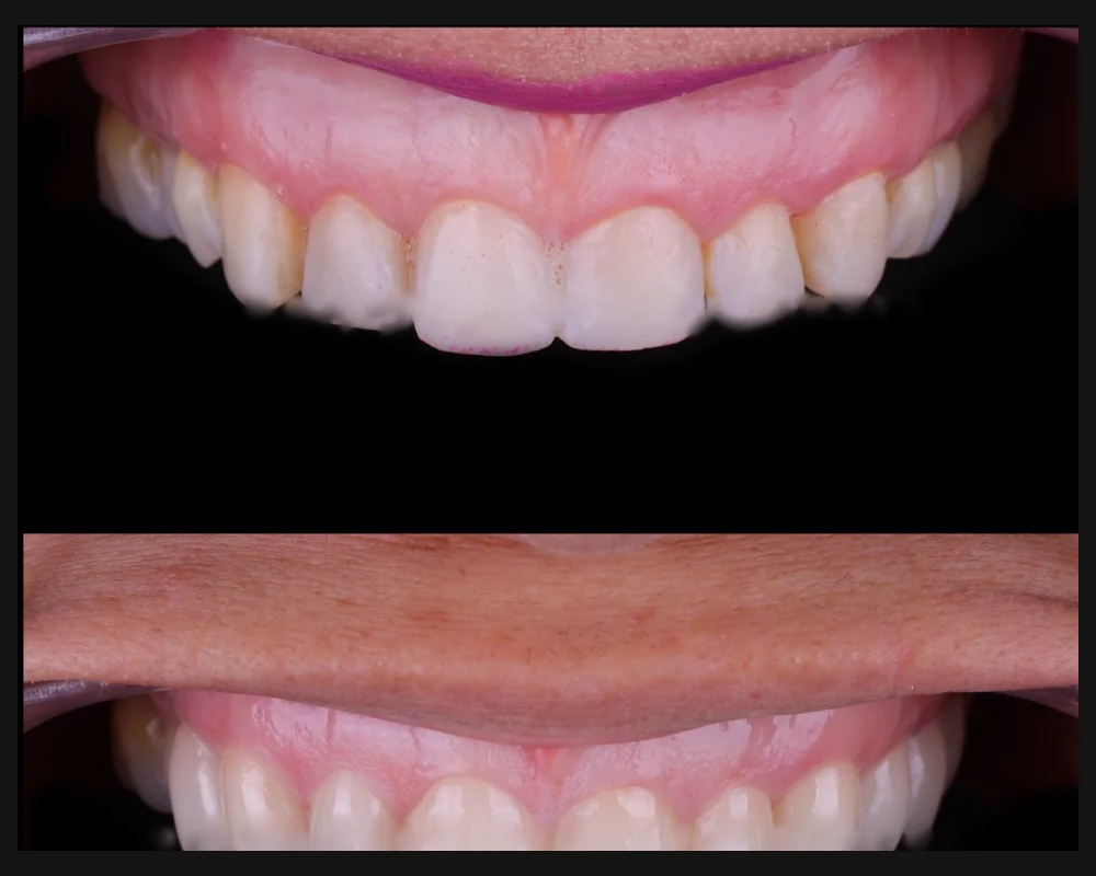 Antes y después de carillas cerámicas en la sonrisa superior