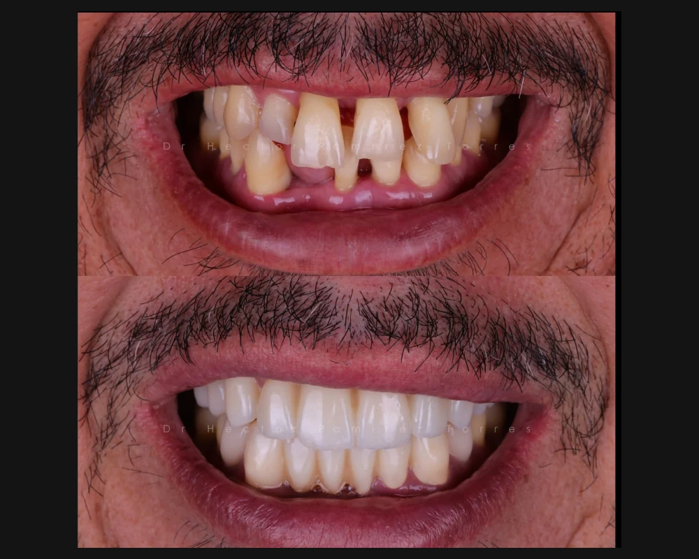 Antes y después de un tratamiento en dientes frontales