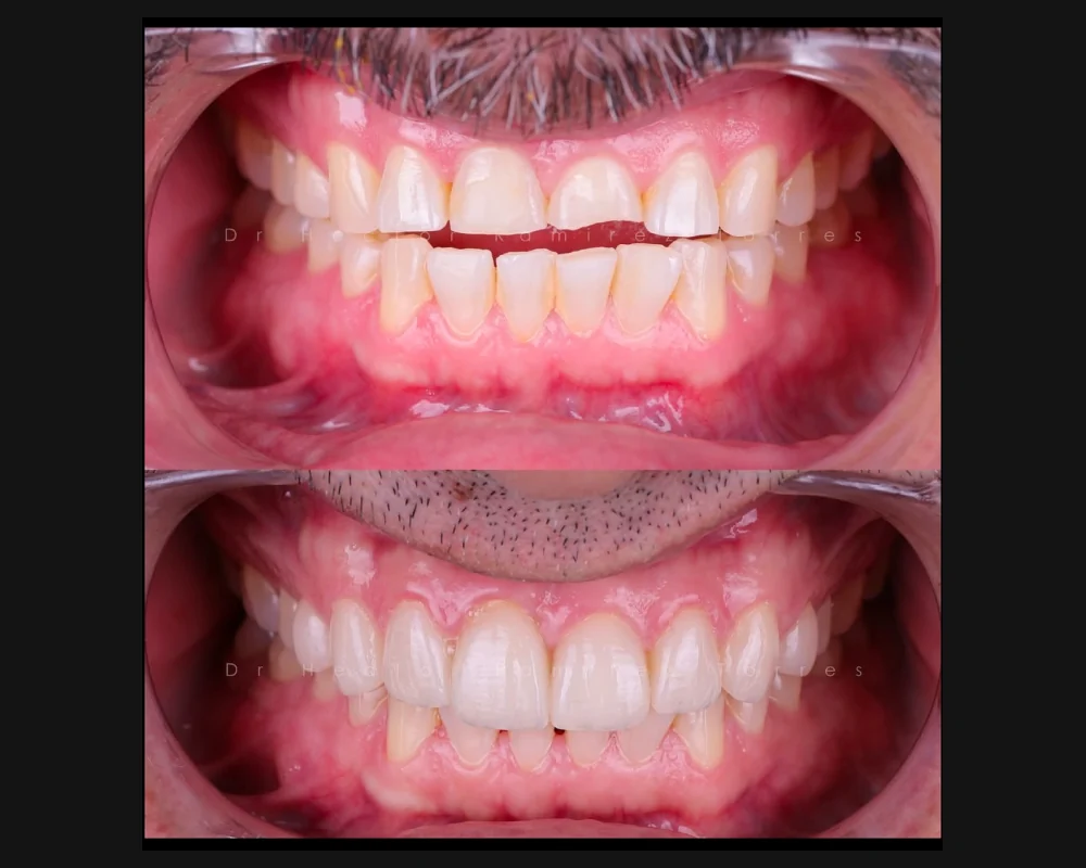 Antes y después de carillas cerámicas en todos los dientes superiores