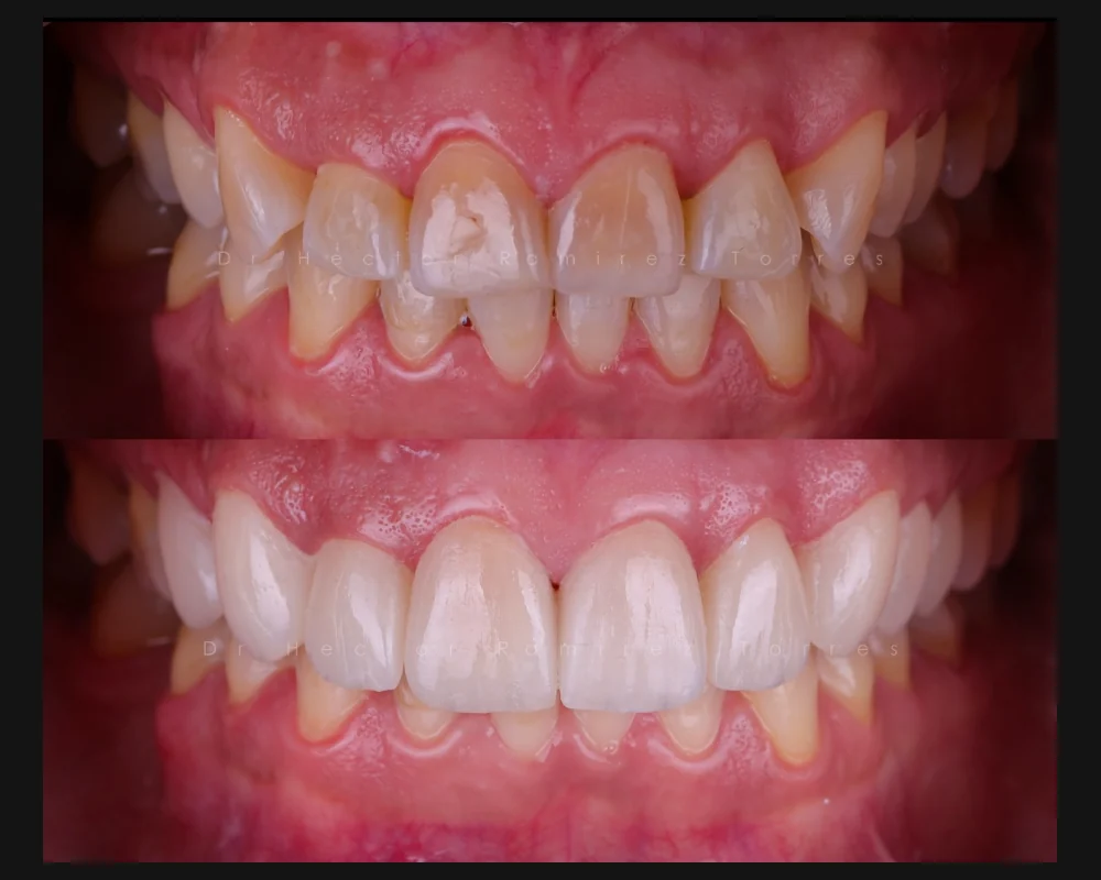Antes y después de carillas cerámicas en dientes superiores manchados