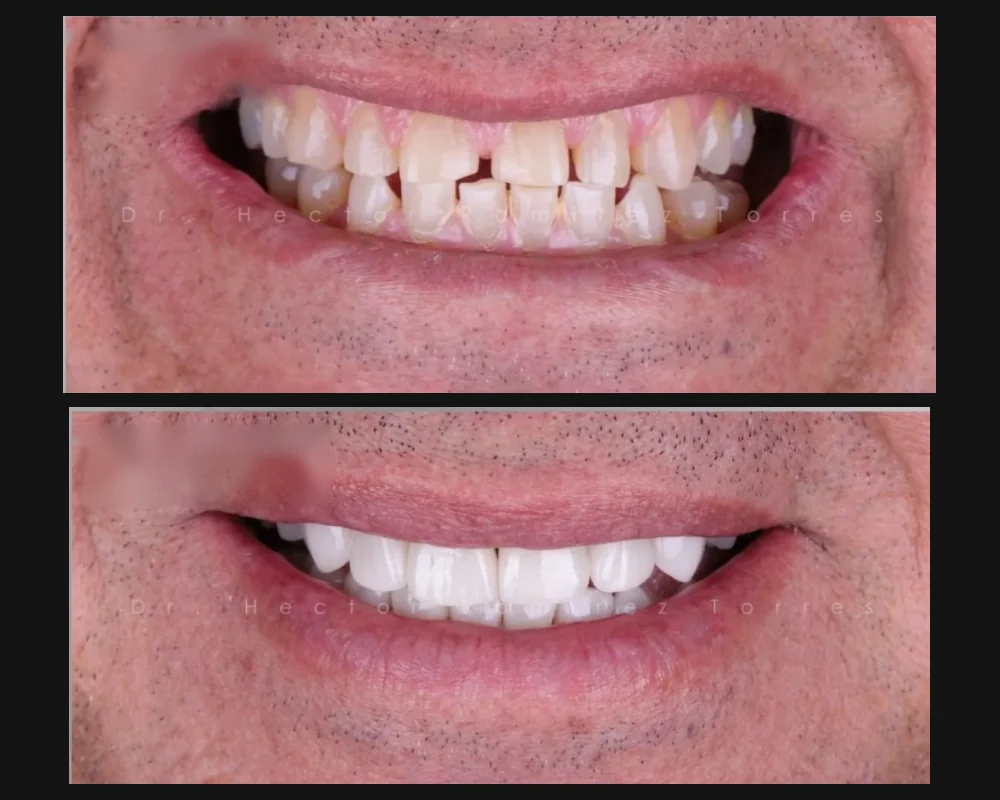 Antes y después de un tratamiento estético en la sonrisa