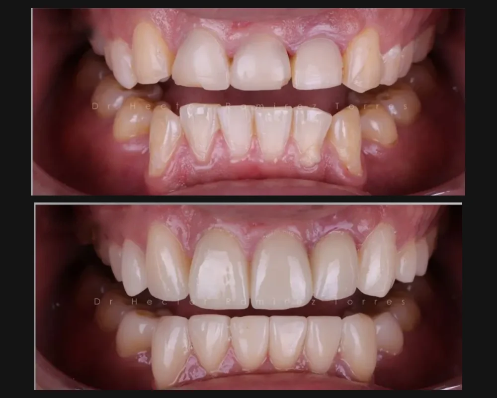 Antes y después de un tratamiento estético en la sonrisa