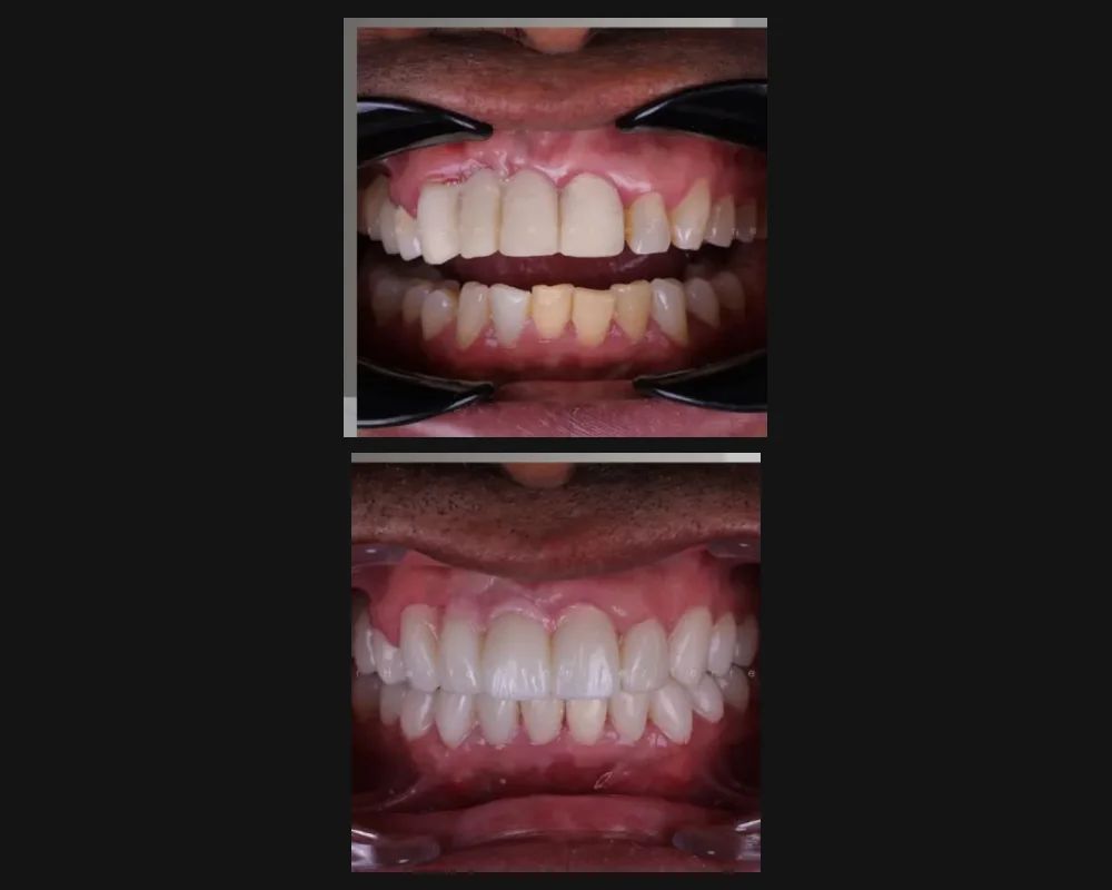 Antes y después de una rehabilitación de la sonrisa