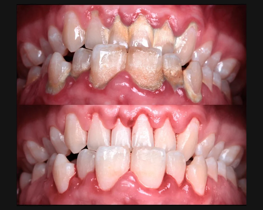 Dientes con sarro y encías inflamadas antes de una limpieza dental, y después de ella
