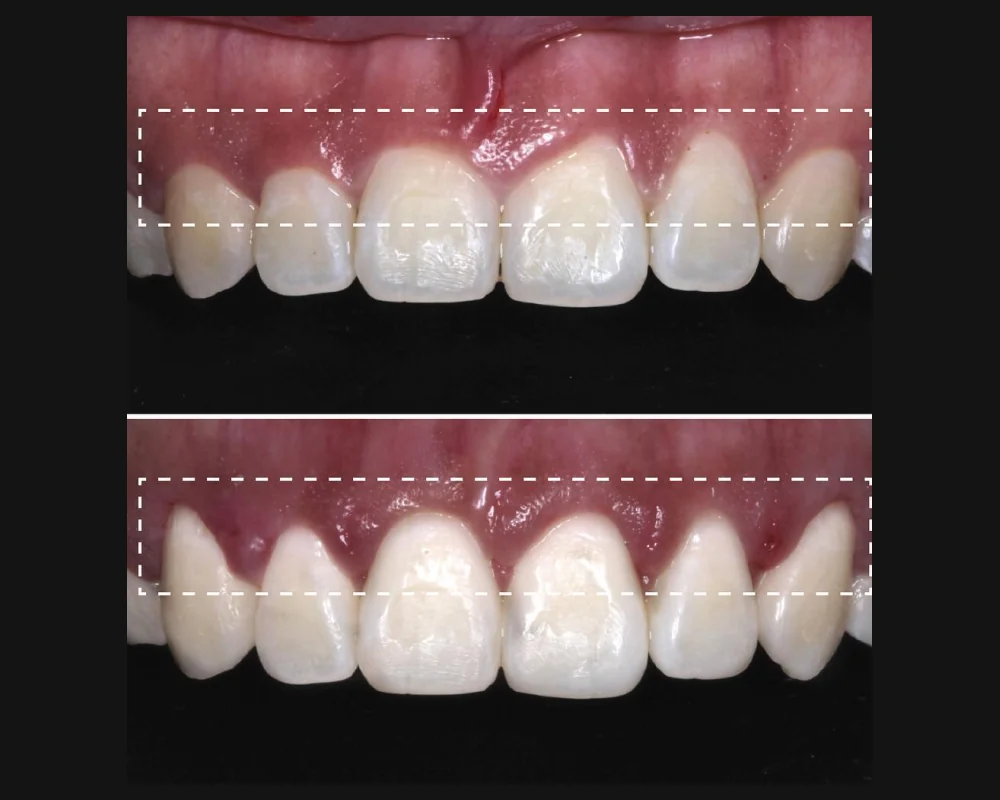 Antes y después de un recontorneo de encía en los dientes superiores
