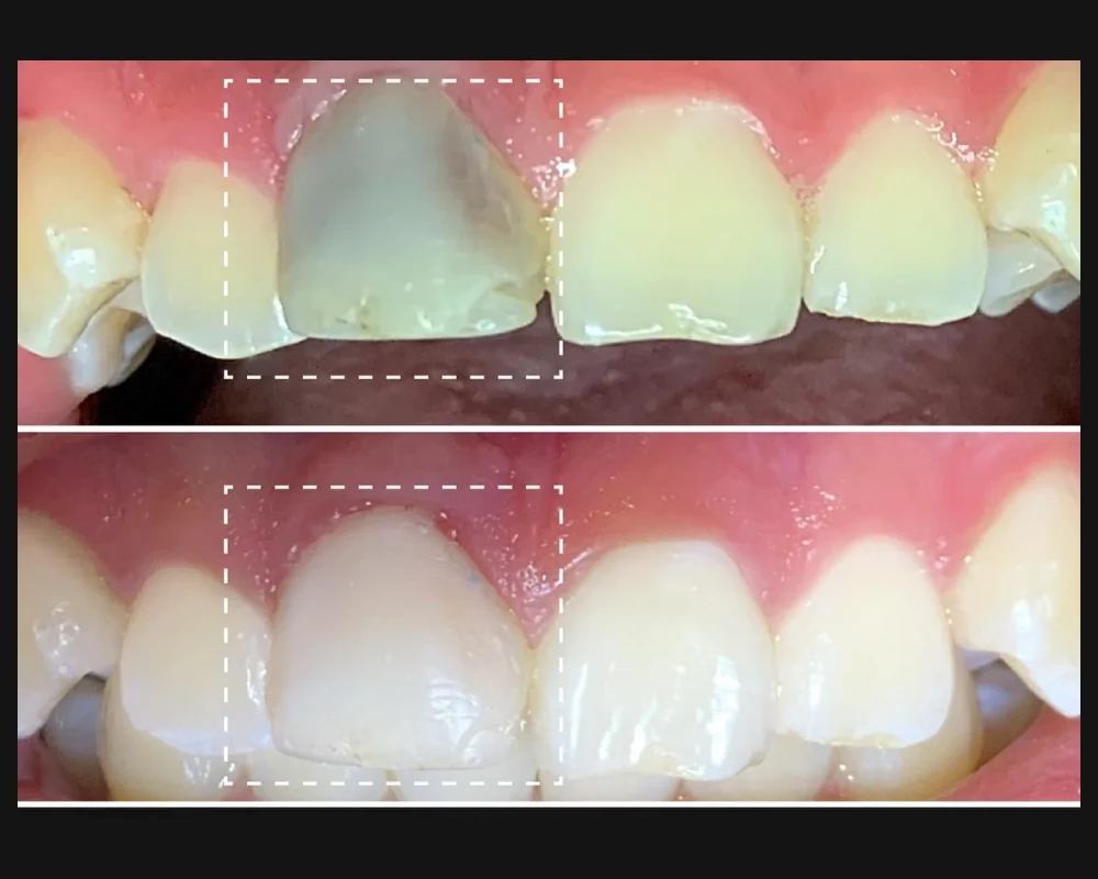 Antes y después del blanqueamiento interno de un diente frontal oscurecido