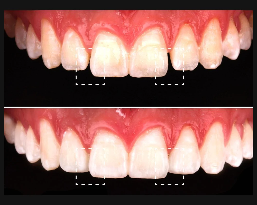 Antes y después del cierre de espacios entre los dientes frontales