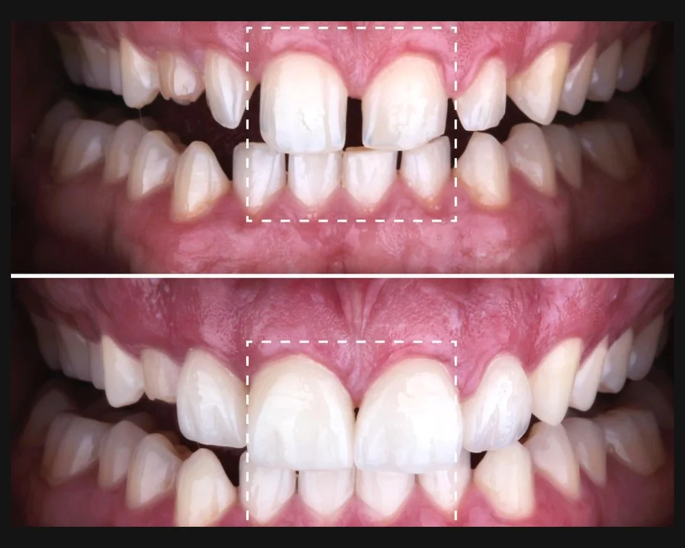 Antes y después de carillas de cerámica en dientes frontales con espacios