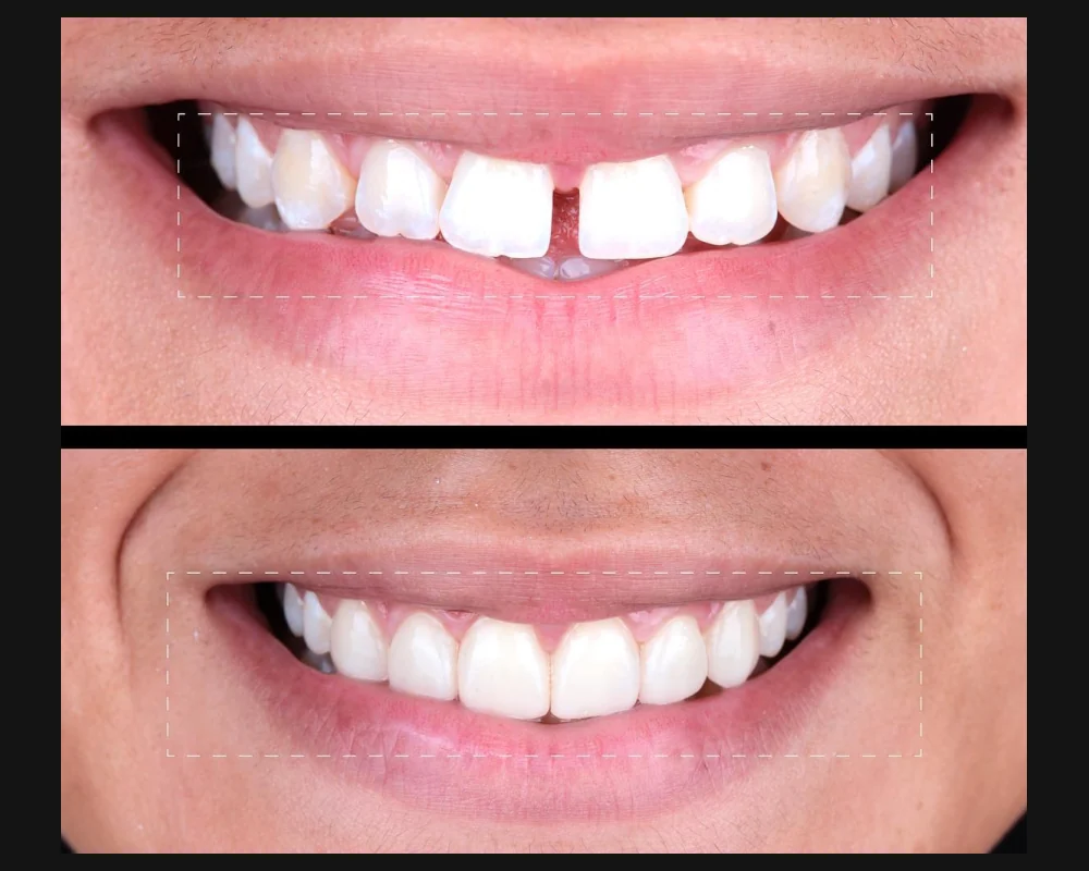 Antes y después de carillas en dientes frontales separados