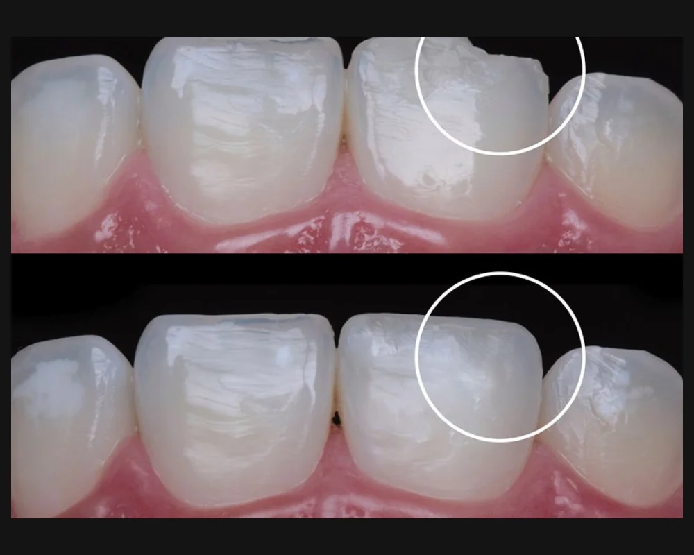 Antes y después de la reconstrucción con resina del borde roto de un diente