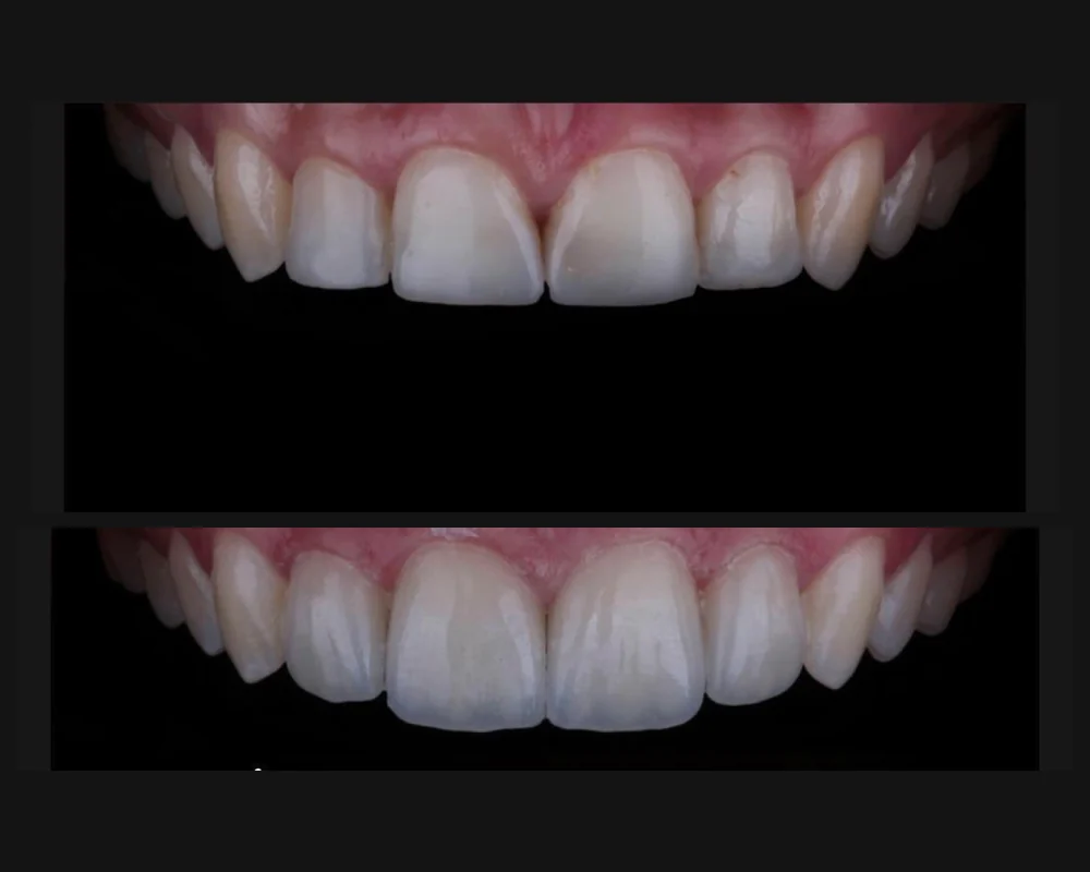 Antes y después de un tratamiento en dientes superiores