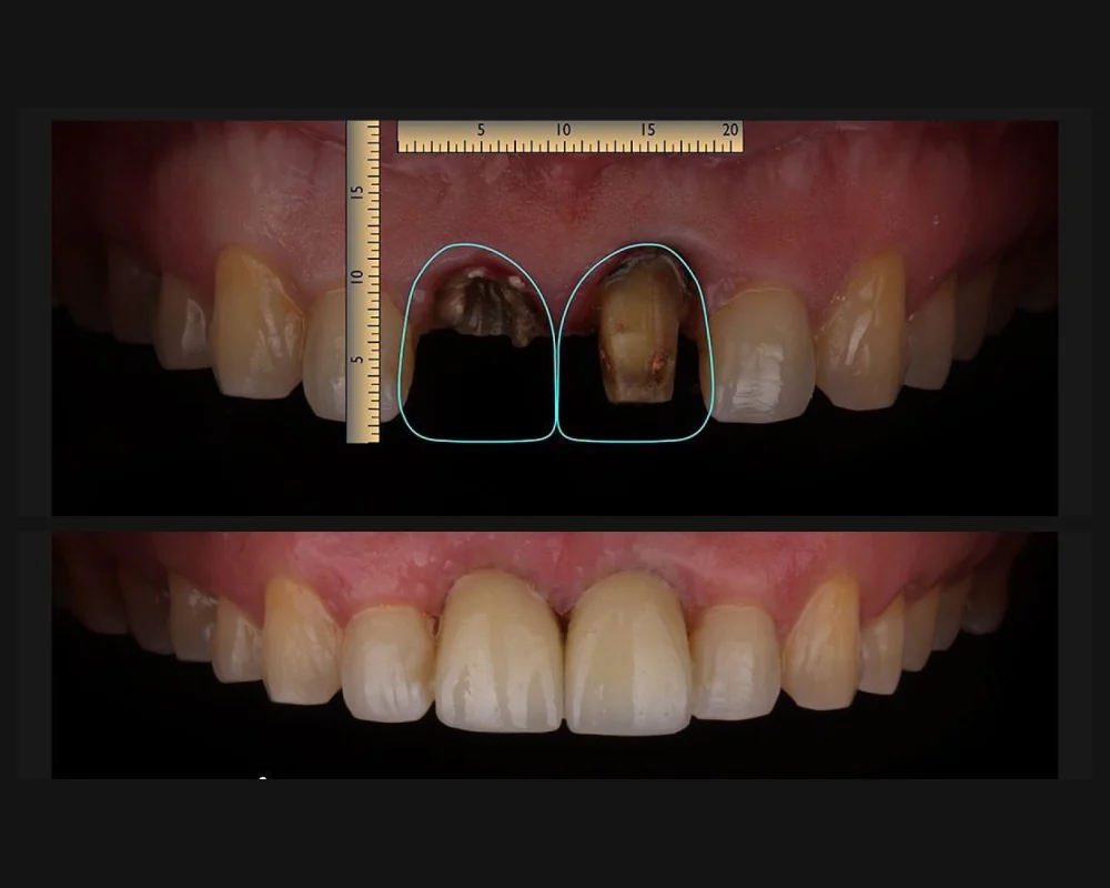 Antes y después de un tratamiento en dientes frontales oscurecidos