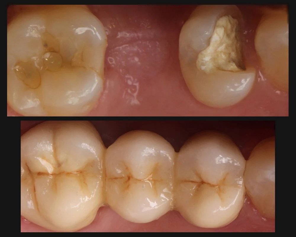Antes y después de una endodoncia con poste y puente en muelas
