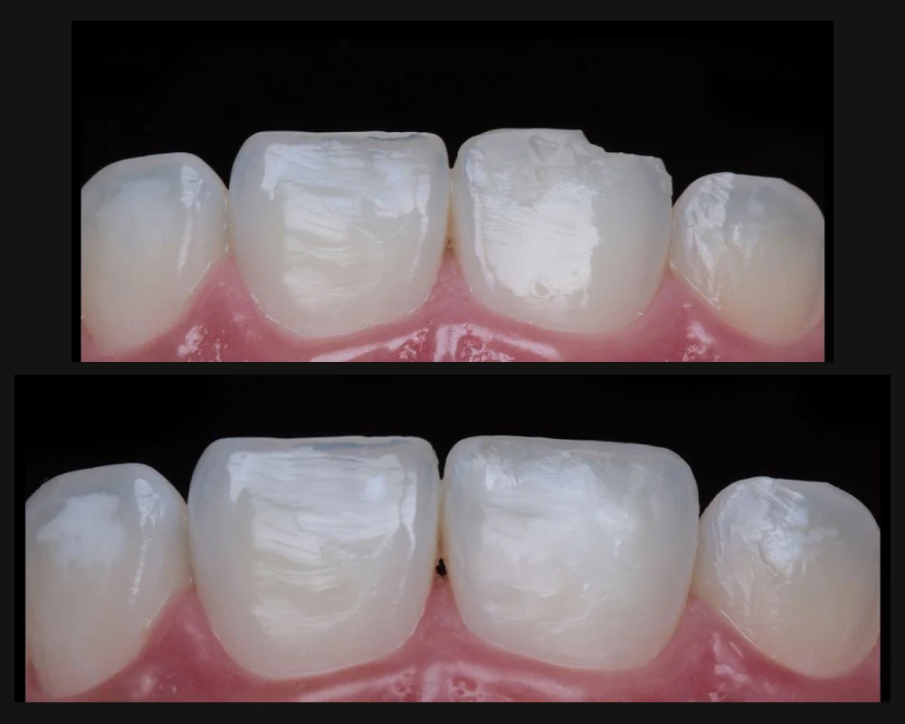 Antes y después de la reconstrucción con resina estética del borde de un diente