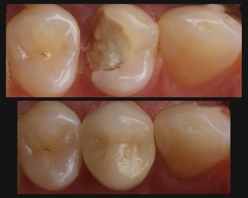 Antes y después de una corona en un premolar con caries y destrucción severa