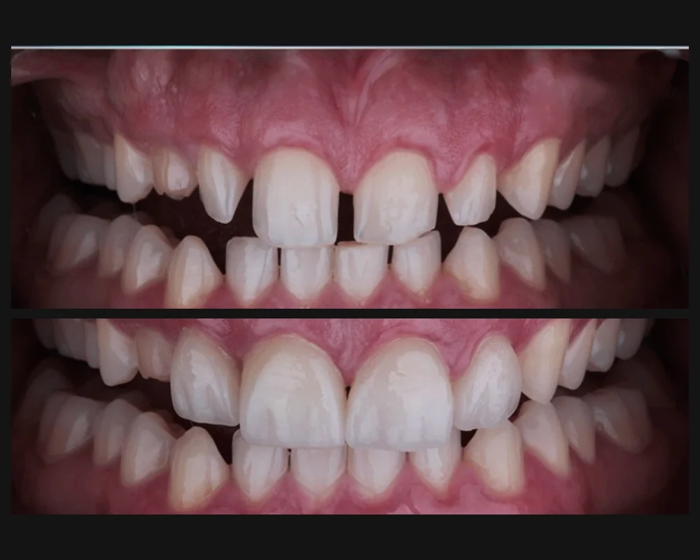 Antes y después de la colocación de carillas de porcelana en dientes frontales