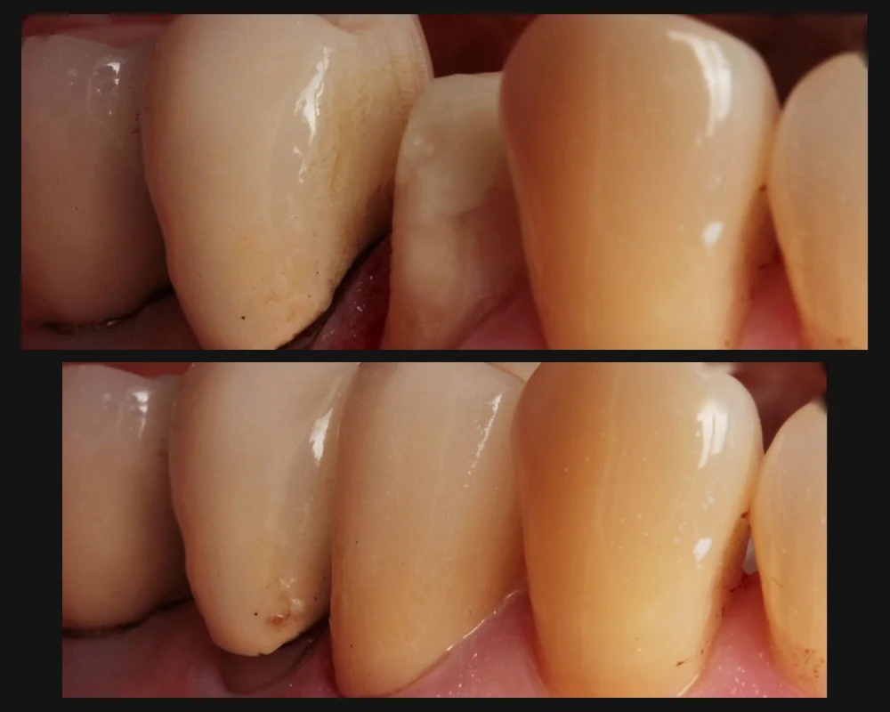 Antes y después de una corona libre de metal en un diente posterior