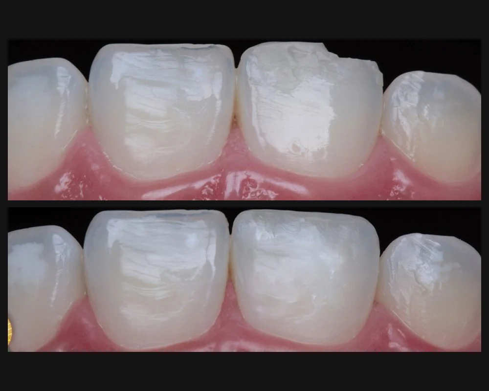 Antes y después de la reparación del borde de dientes inferiores