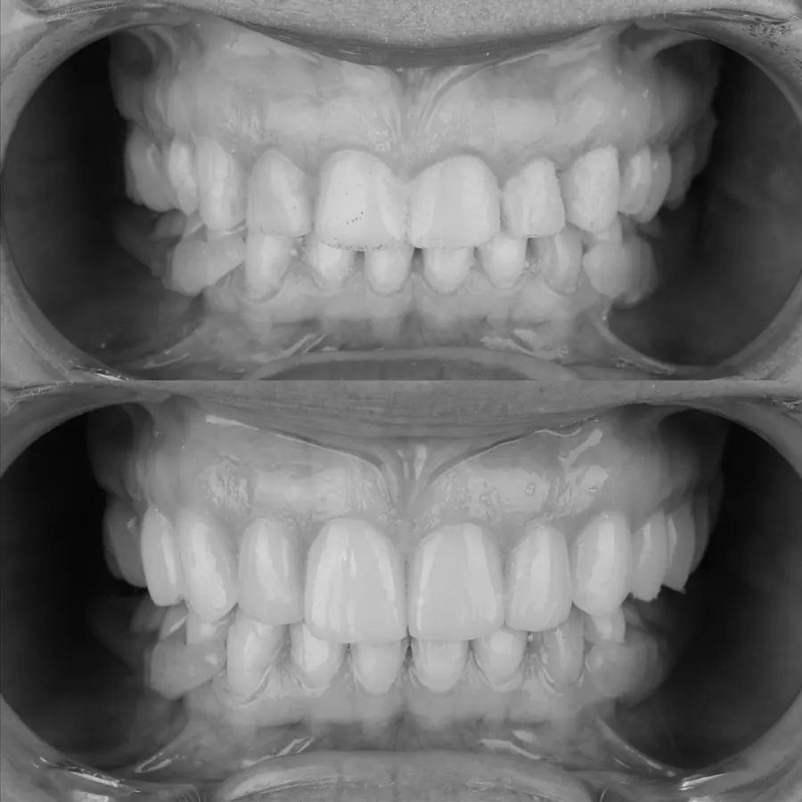 Antes y después de un diseño de sonrisa con carillas cerámicas, en blanco y negro
