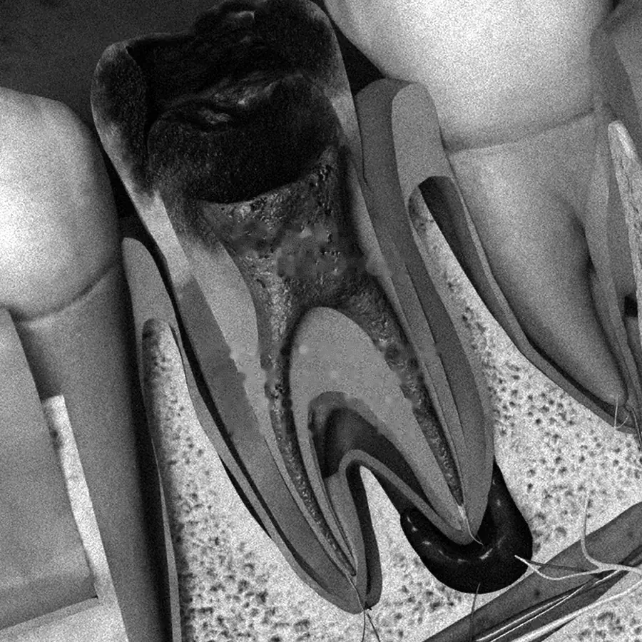 Corte de un diente con su raíz y el hueso que lo rodea, en blanco y negro
