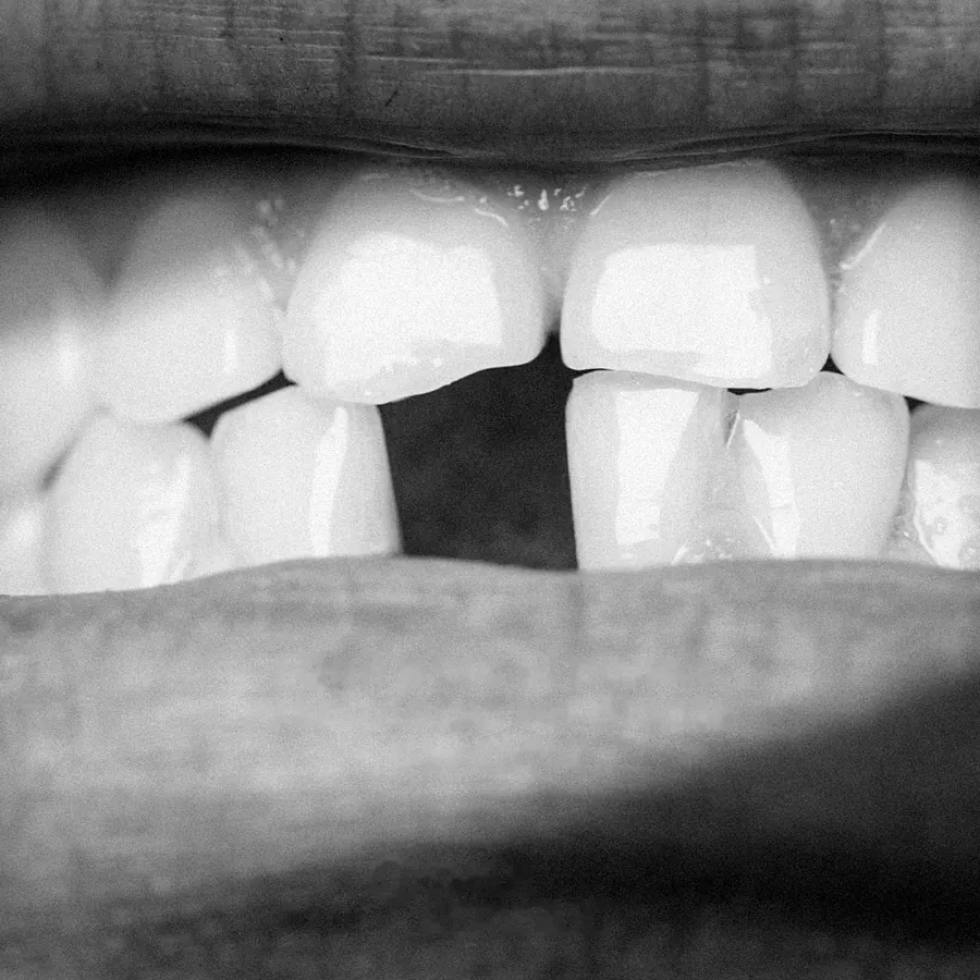 Hueco de un diente perdido entre los dientes frontales, en blanco y negro