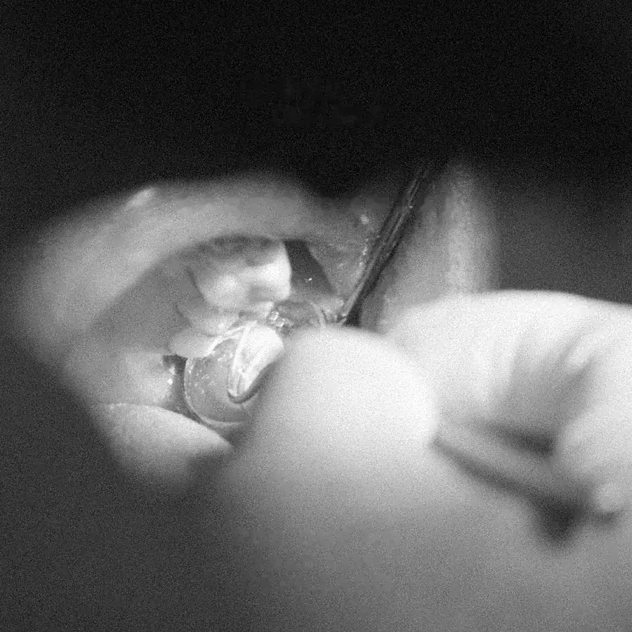 Dentista retirando sarro dental durante una limpieza, en blanco y negro