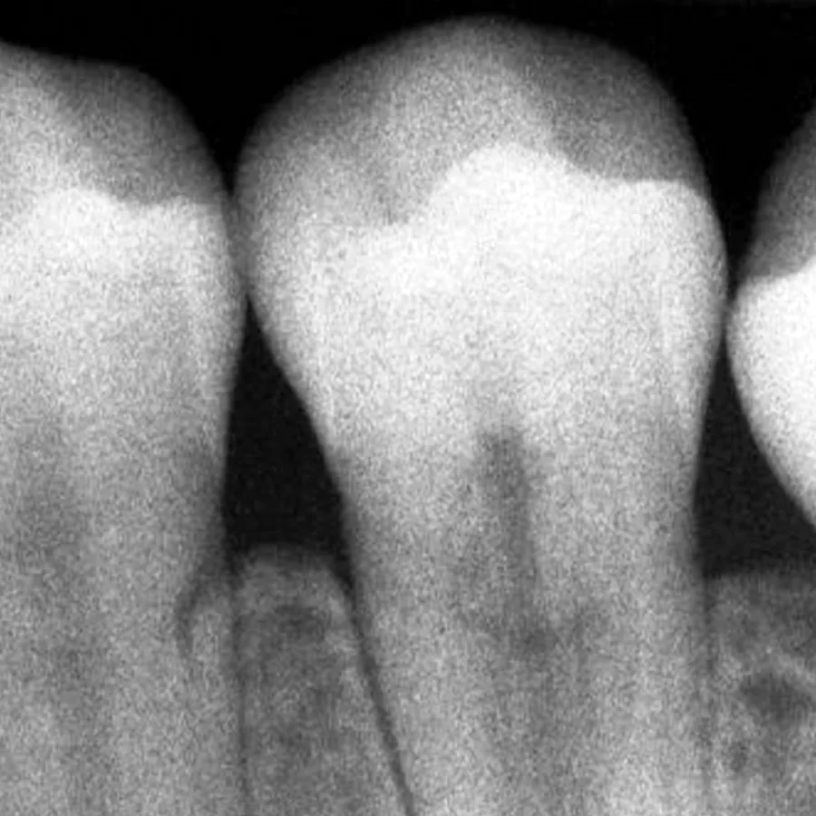 Radiografía de los dientes y el hueso de la mandíbula