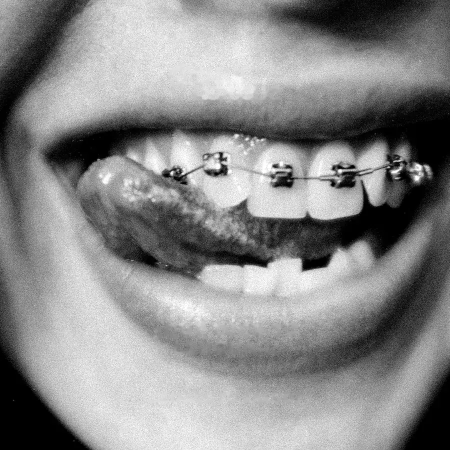 Sonrisa con brackets metálicos, en blanco y negro