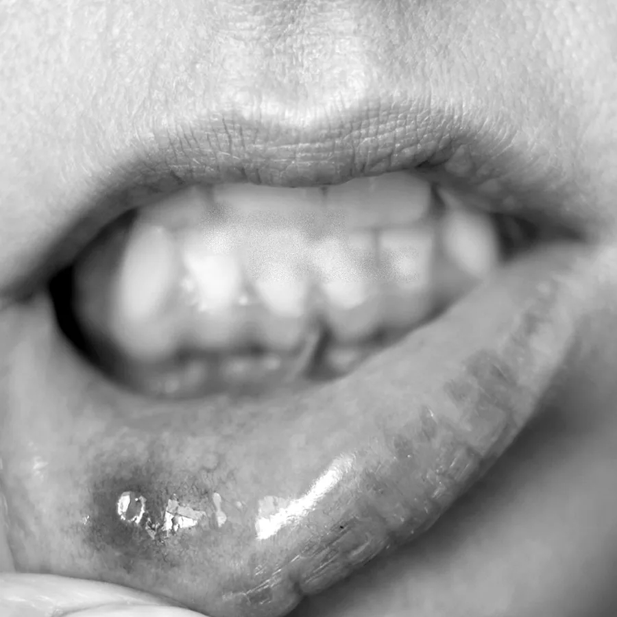 Boca de una paciente que señala con el dedo una lesión en el labio inferior, en blanco y negro