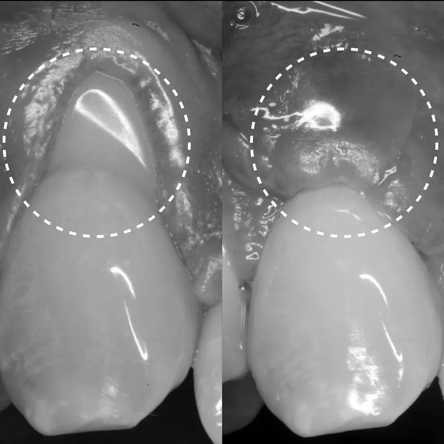 Antes y después de una cobertura radicular en un diente con la encía retraída, en blanco y negro